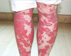 银屑病外用药有什么讲究