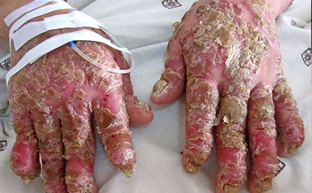 银屑病造成的危害