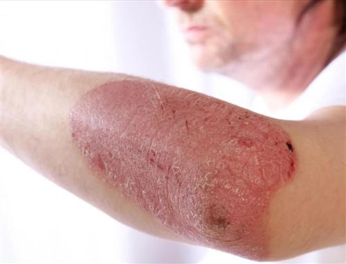 银屑病发生后易造成的危害有哪些