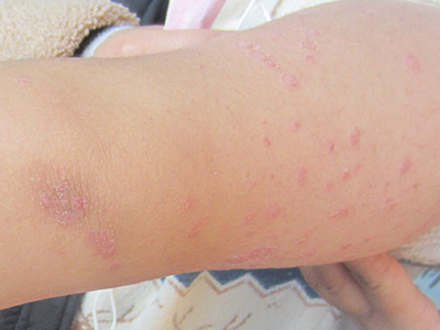 点滴状银屑病有什么特点