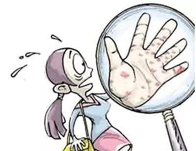 与牛皮癣患者接触会被传染吗