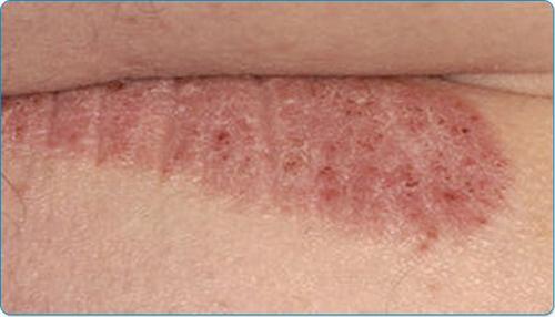 偏方治疗牛皮癣会扩散